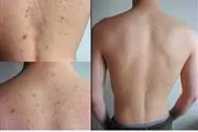 ESPALDA ACNE Y CELULAS MUERTAS en Los Angeles