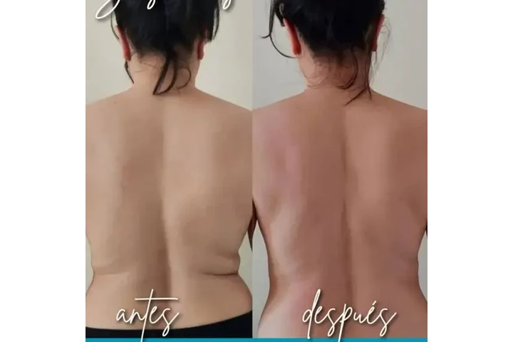 Lipo láser image 3
