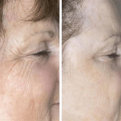 REJUVENE FACIAL MANCHAS  ACNE image 2