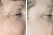 REJUVENE FACIAL MANCHAS  ACNE thumbnail