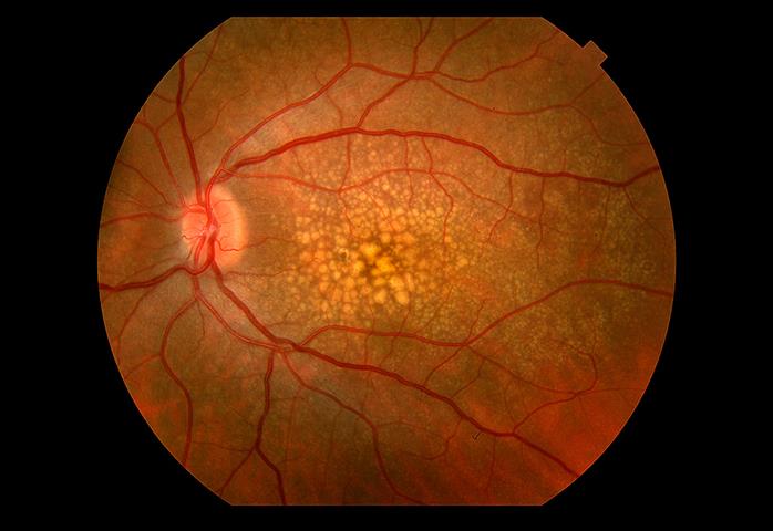 Macular degeneration doctors image 2