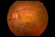 Macular degeneration doctors thumbnail