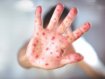 Cómo proteger a los niños contra el sarampión