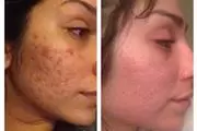 FACIAL MICRODERMABRASION thumbnail