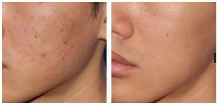 MICRONEEDLING NANO FACIAL image 3