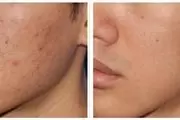 MICRONEEDLING NANO FACIAL thumbnail