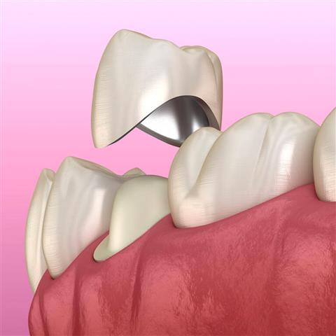 Implantes Dentales en Rialto image 1