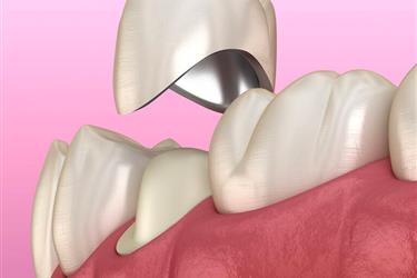Implantes Dentales en Rialto en San Bernardino