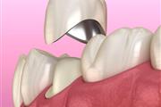 Implantes Dentales en Rialto en San Bernardino