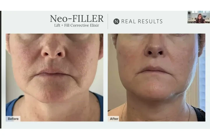NEO FILLER ALTERNATIVA A BOTOX image 2