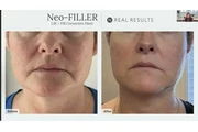 NEO FILLER ALTERNATIVA A BOTOX thumbnail