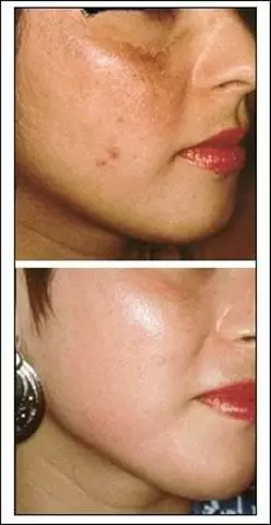 FACIAL ACNE LIMPIEZA PROFUNDA image 4