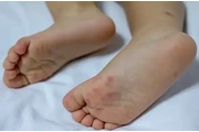 Paediatric Athletes Foot en Australia