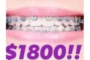 TRATAMIENTO DE BRACKETS thumbnail