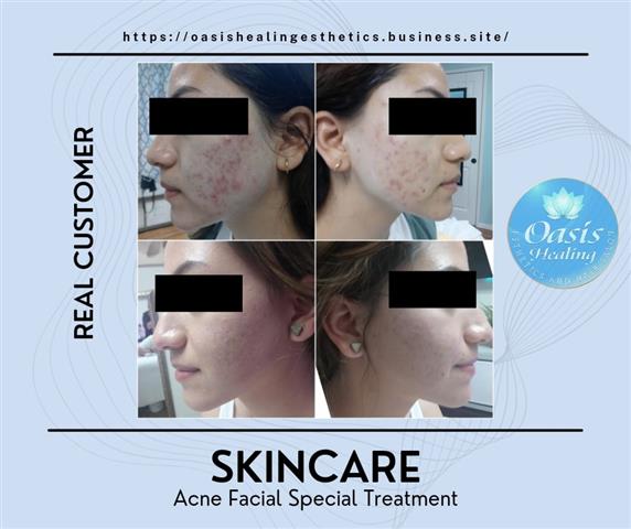 REJUVENE FACIAL MANCHAS  ACNE image 4