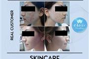 REJUVENE FACIAL MANCHAS  ACNE thumbnail